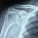 Schulter im Röntgenbild